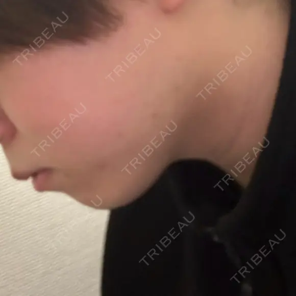 ヒアルロン酸注入（あご） ヴェリテクリニック 大阪院 BEFORE メイン用