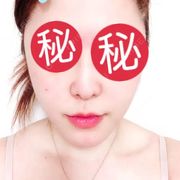 鼻中隔延長（切開） / 骨切り（あご） / 骨削り（エラ） / 軟骨移植 / 眉間プロテーゼ id（アイディ）美容外科 BEFORE メイン用