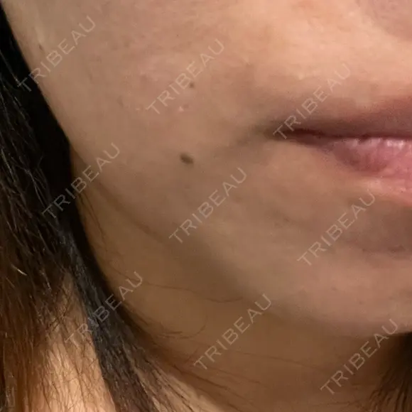 ほくろ・いぼ切除（肌） R Beauty CLINIC 名古屋院 BEFORE メイン用