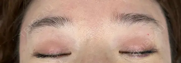 アートメイク（眉） 東京中央クリニック BEFORE メイン用