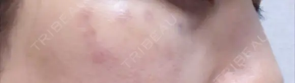 ピコスポット G MEDICAL ART クリニック 新宿院 BEFORE メイン用