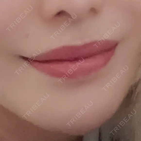 ヒアルロン酸注入（唇） / ボトックス（口角） / ボトックス（人中） / その他（口元） 東京銀座A CLINIC デンタル BEFORE メイン用