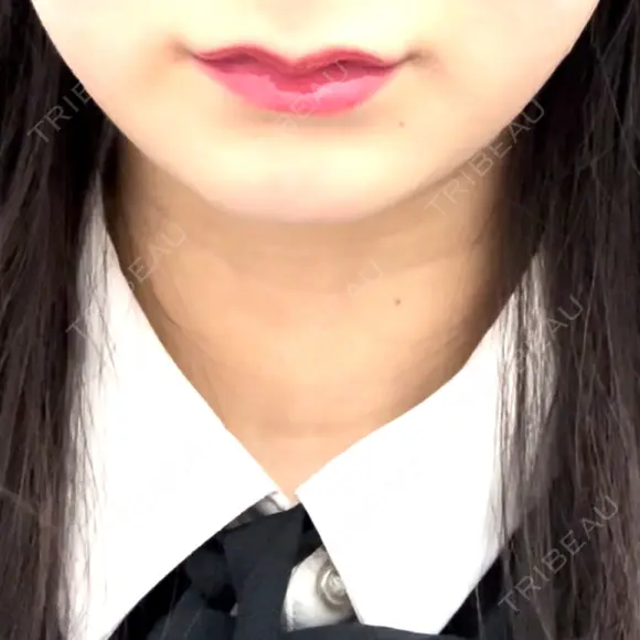 ヒアルロン酸注入（あご） 銀座美容外科クリニック 新宿院 BEFORE メイン用