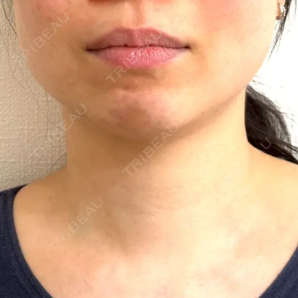 ボトックス（あご） / ボトックス（エラ・小顔） / ハイフ（顔） もとび美容外科クリニック 新宿院 BEFORE メイン用