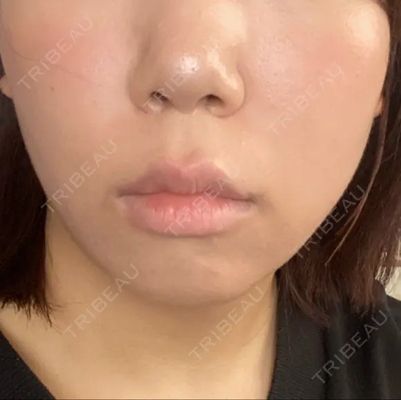 ハイフ（顔） 表参道美容外科クリニック BEFORE メイン用