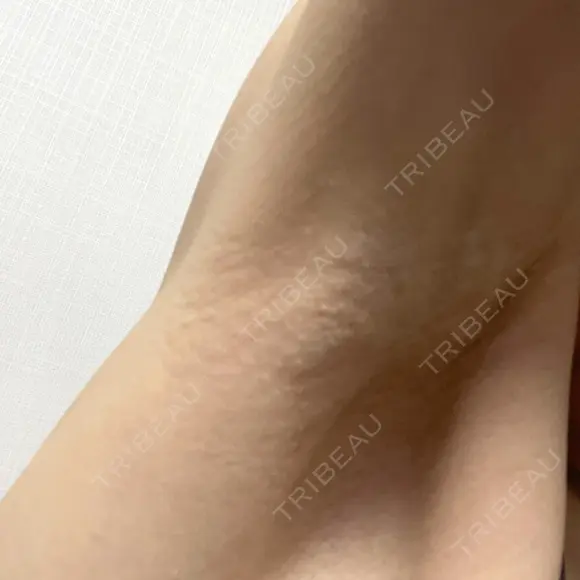 ワキ汗治療（切開） 石倉クリニック 水戸院 BEFORE メイン用