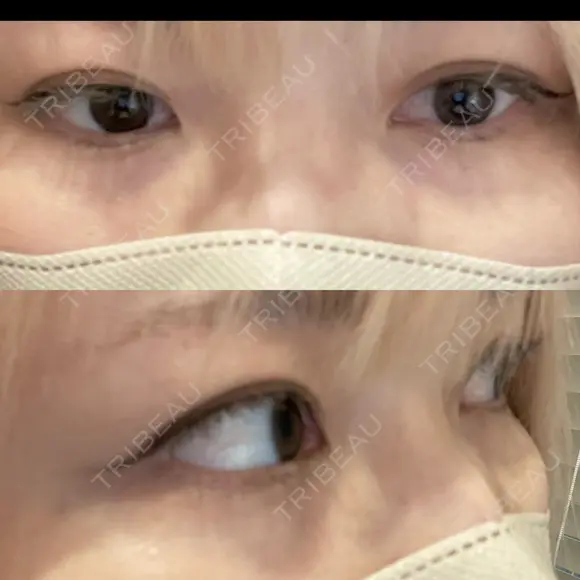 ヒアルロン酸注入（涙袋） ファイヤークリニック 渋谷院 BEFORE メイン用