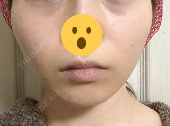 骨削り（頬） 湘南美容クリニック 新橋銀座口院 BEFORE メイン用