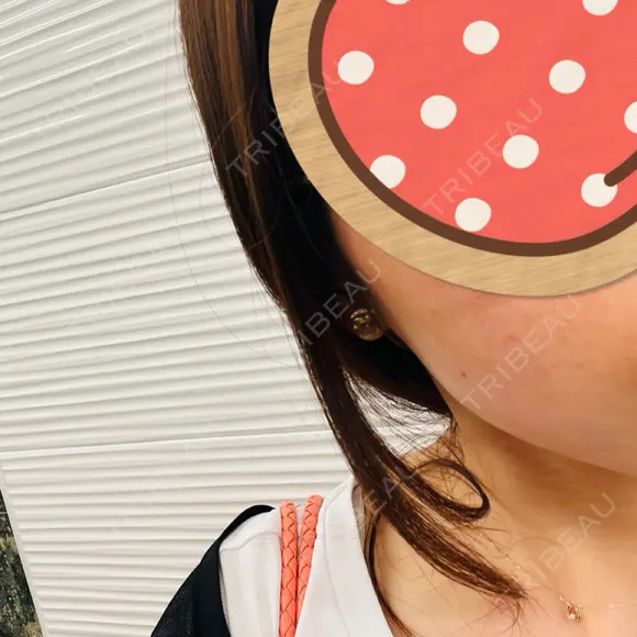 医療脱毛（顔） S-Laboクリニック 渋谷院 BEFORE メイン用