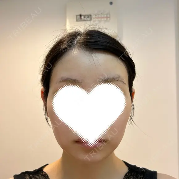 額を丸く / 脂肪吸引（二の腕） / こめかみ形成 / 脂肪注入（額） / 脂肪吸引（肩） / 脂肪注入（輪郭） Mods Clinic（モッズクリニック） 名古屋院 BEFORE メイン用