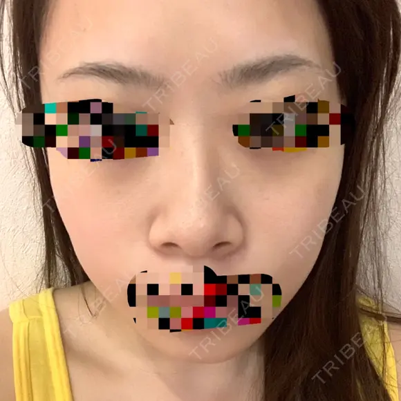 小鼻縮小（切開） / スレッドノーズ / 鼻尖縮小 / ヒアルロン酸注入（鼻） キップン整形外科 BEFORE メイン用