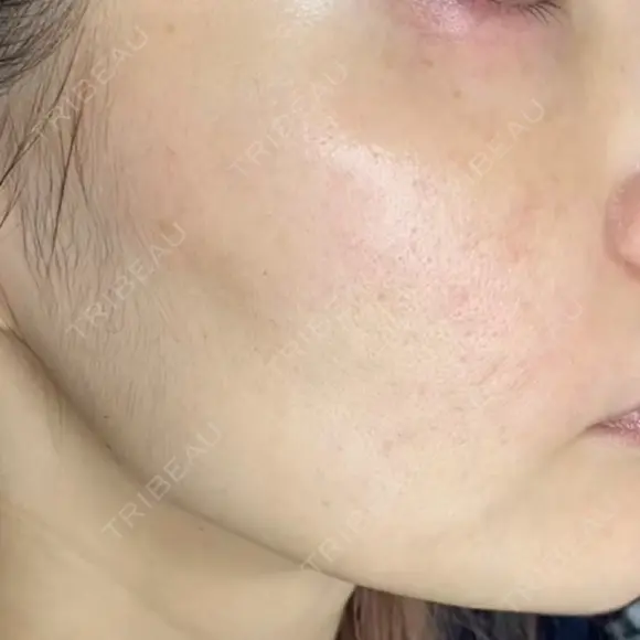 その他（肌） / ポテンツァ オラクル美容皮膚科 大阪梅田院 BEFORE メイン用