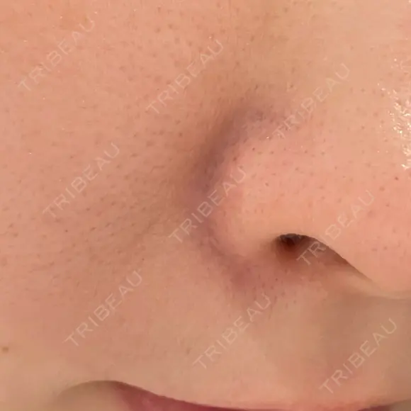 ピーリング（ハリ・ツヤ） Re:anne clinic 銀座 【リアンクリニック銀座】 BEFORE メイン用