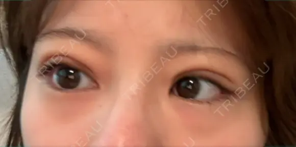 下まぶたの脂肪取り APOLLO BEAUTY CLINIC BEFORE メイン用
