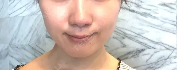 ボトックス（エラ・小顔） ルラ美容クリニック 札幌本院 BEFORE メイン用