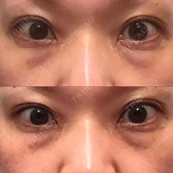 下まぶたたるみ取り セオリークリニック BEFORE メイン用