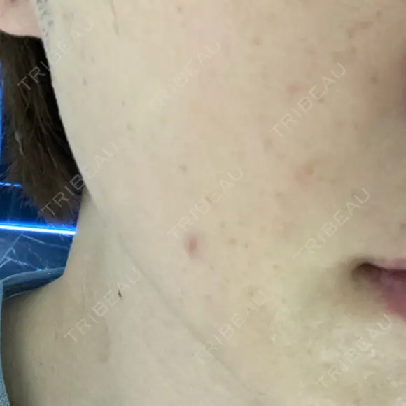 ピーリング（ニキビ・毛穴） Tokyo Tensei Clinic 銀座院 BEFORE メイン用