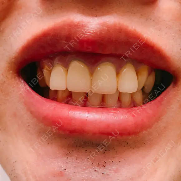 セラミック 東京美容外科 赤坂院 BEFORE メイン用