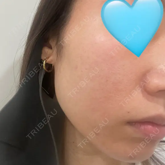 医療痩身（顔） 渋谷美容外科クリニック 横浜院 BEFORE メイン用