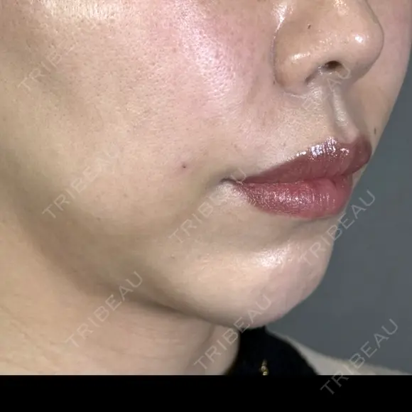 ヒアルロン酸注入（頬） アリエル美容クリニック 郡山院 BEFORE メイン用
