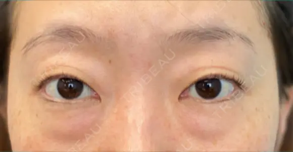 クマ治療 / 下まぶたたるみ取り / 下まぶたの脂肪取り / 脂肪注入（目の下） 湘南美容クリニック 千葉センシティ院 BEFORE メイン用