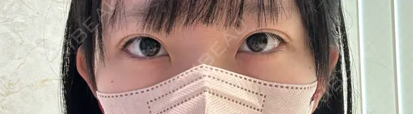 目頭切開 / クマ治療 / 目尻切開 / 下まぶたの脂肪取り / タレ目形成・グラマラスライン（切開） / タレ目形成・グラマラスライン（埋没） / ヒアルロン酸注入（涙袋） / ボトックス（エラ・小顔） Tokyo Tensei Clinic 銀座院 BEFORE メイン用