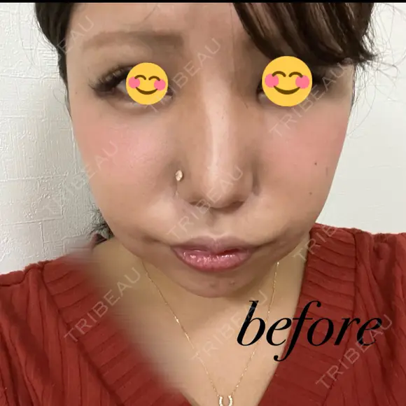 ヒアルロン酸注入（鼻） / ヒアルロン酸注入（あご） / 美容点滴・美容注射（疲労回復） HAAB×DREAM BEAUTY CLINIC 大阪梅田院 BEFORE メイン用