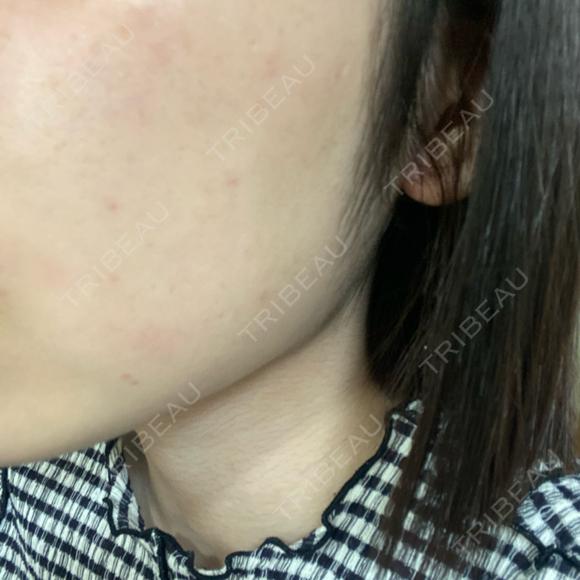 医療脱毛（顔） 共立美容外科 熊本院 BEFORE メイン用