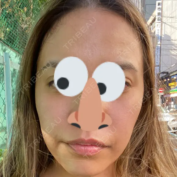 水光注射（ハリ・美肌） 小木曽クリニック BEFORE メイン用