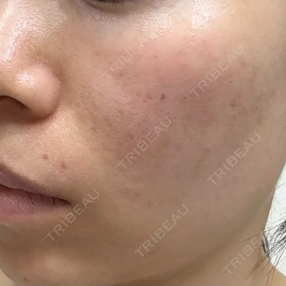 エレクトロポレーション / フォトシルクプラス もとび美容外科クリニック 新宿院 BEFORE メイン用
