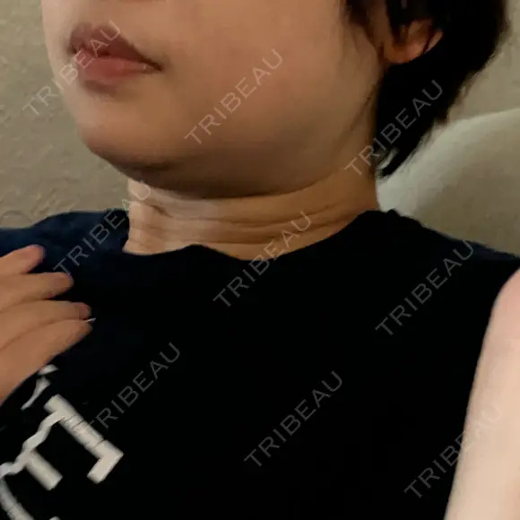 脂肪吸引注射（顔） 湘南美容クリニック 仙台院 BEFORE メイン用