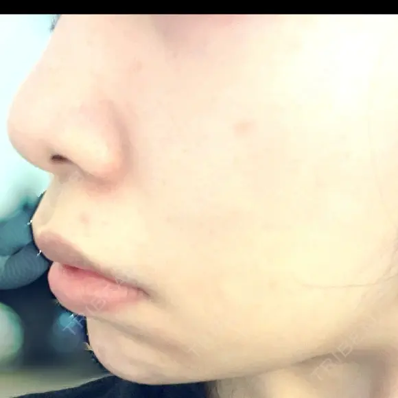 ヒアルロン酸注入（あご） / ヒアルロン酸注入（鼻翼基部） KAGA CLINIC BEFORE メイン用