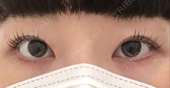 二重埋没 / ボトックス（エラ・小顔） / ボトックス（肩） THE FIRST CLINIC 多摩センター院 BEFORE メイン用