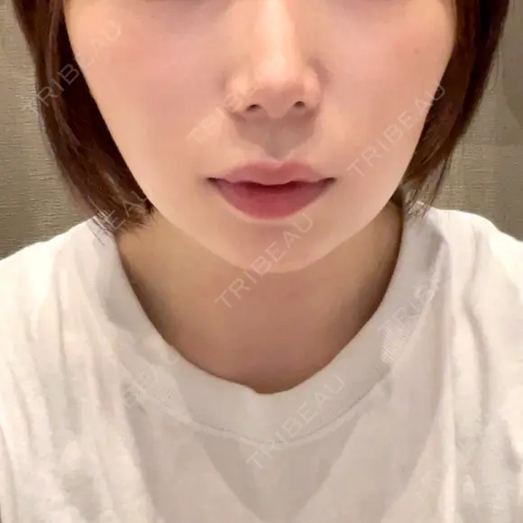 インディバ（顔） WOM SALON【術後ケア取扱いサロン】 BEFORE メイン用