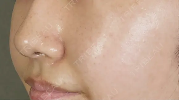 脂肪溶解注射（顔） アリエル美容クリニック 郡山院 BEFORE メイン用