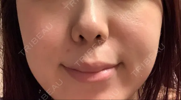 その他（肌） ゆきスキンクリニック 東池袋 BEFORE メイン用