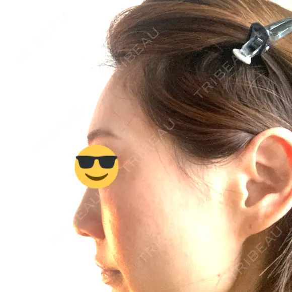 脂肪注入（肌） / こめかみ形成 / 脂肪注入（額） / 脂肪注入（輪郭） Mods Clinic（モッズクリニック） 福岡院 BEFORE メイン用