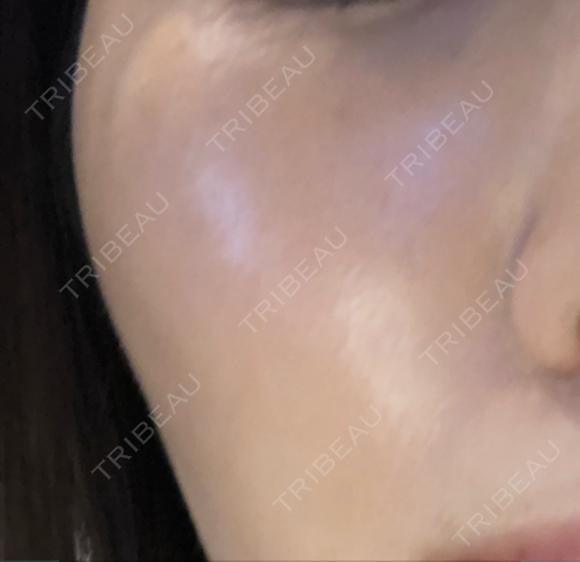 水光注射（ハリ・美肌） プチパーティー医院 BEFORE メイン用
