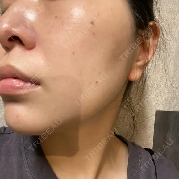 エレクトロポレーション / 光治療（フォトフェイシャルなど） / ルメッカ ゆきスキンクリニック 東池袋 BEFORE メイン用