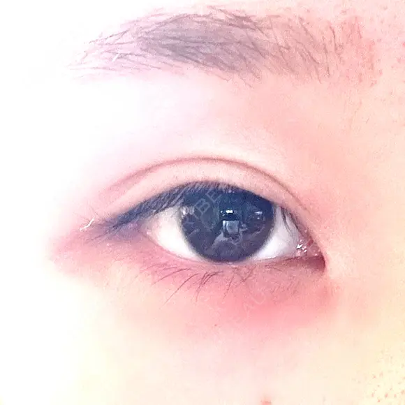 その他（目元） グリシーヌクリニック BEFORE メイン用