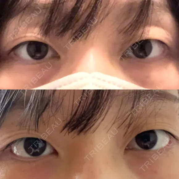 二重埋没 BELINDA CLINIC（ベリンダクリニック）新宿院 BEFORE メイン用
