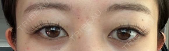 自然癒着法 / 眼瞼下垂（非切開） LUHO（ルホ）美容外科 BEFORE メイン用