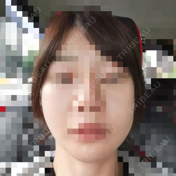 ボトックス（エラ・小顔） 品川美容外科 仙台院 BEFORE メイン用