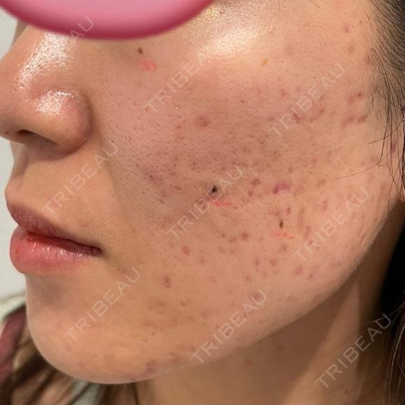 ほくろ・いぼ切除（肌） R Beauty CLINIC 名古屋院 BEFORE メイン用