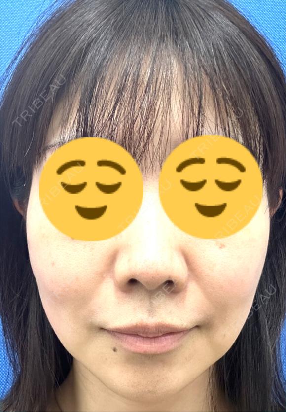 糸リフト 湘南美容クリニック 岡山院 BEFORE メイン用