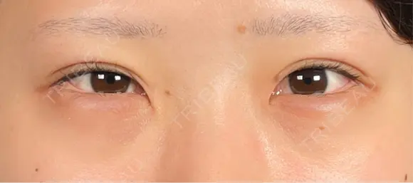 クマ治療 R Beauty CLINIC 銀座院 BEFORE メイン用