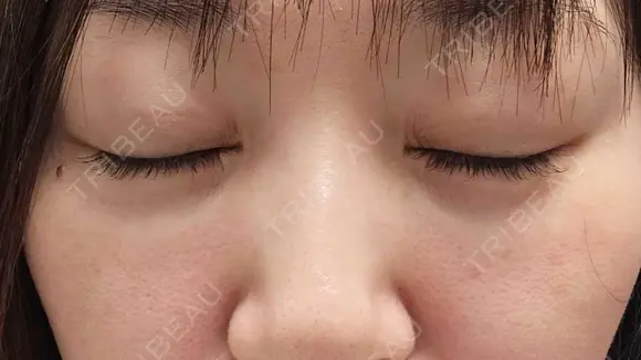 スネコス REVO CLINIC PLUS BEFORE メイン用