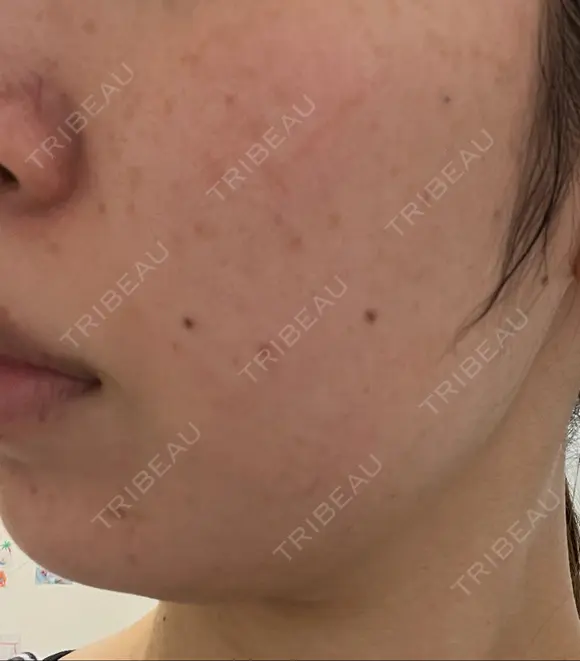 RF（高周波）たるみ治療 東京美容医療クリニック 池袋院 BEFORE メイン用