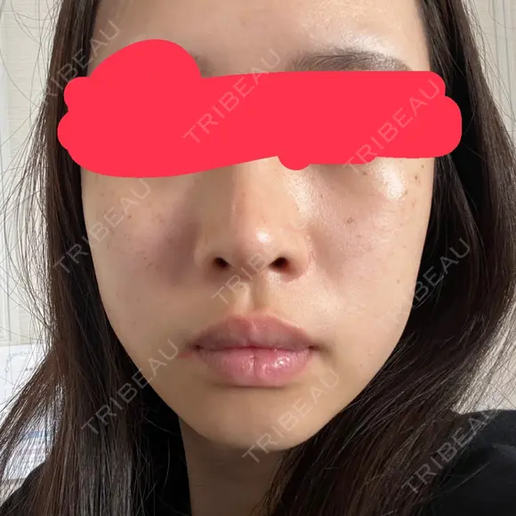 イオン導入 / ピーリング（ハリ・ツヤ） / ルメッカ ルラ美容クリニック 札幌本院 BEFORE メイン用