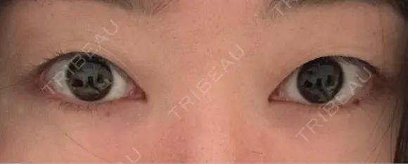 二重埋没 Brandnew Beauty Clinic BEFORE メイン用